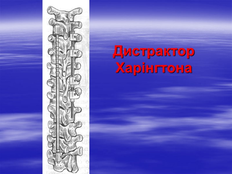 Дистрактор Харінгтона